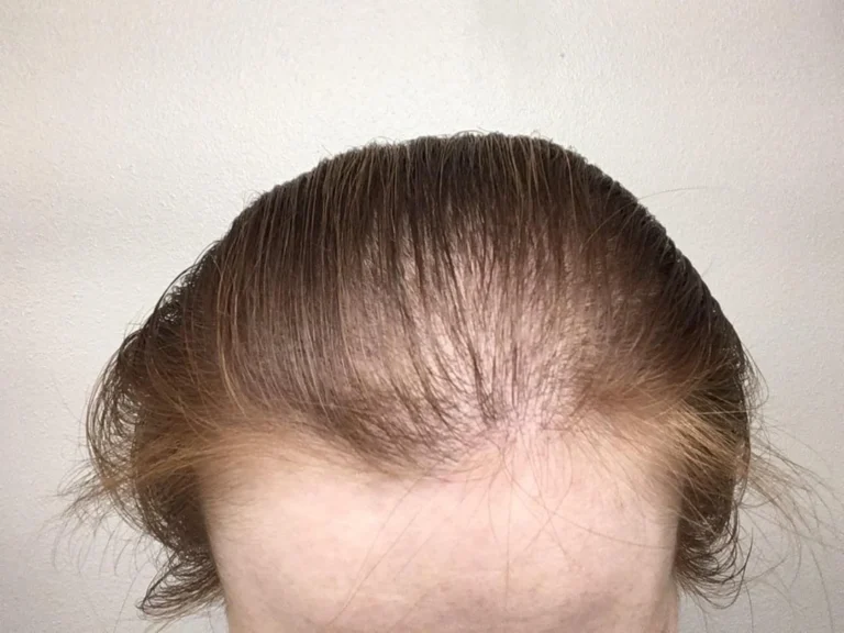 does mielle shampoo cause hair loss